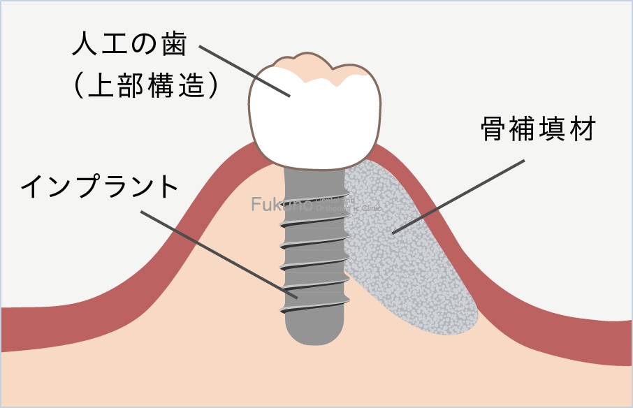 GBR(骨造成)の説明図