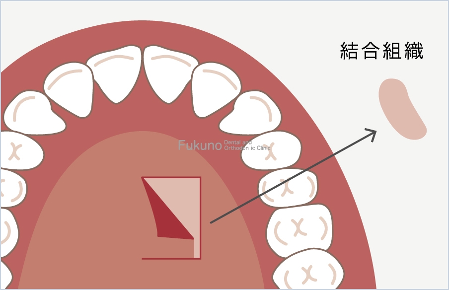 粘膜移植手術の説明図