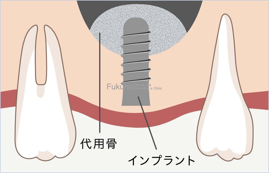 ソケットリフトの説明図