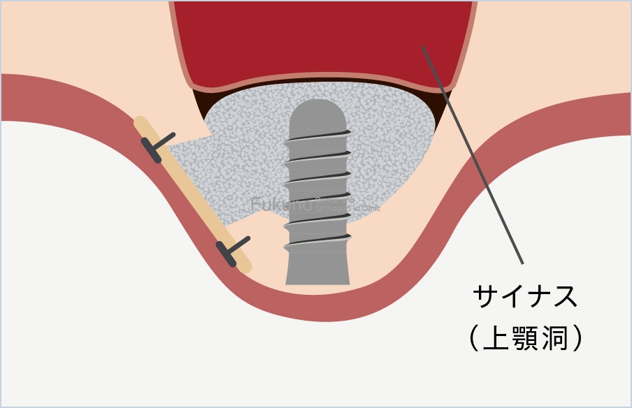 サイナスリフトの説明図